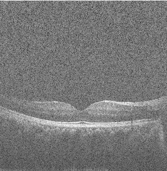 Figure 3 for State-of-the-Art in Retinal Optical Coherence Tomography Image Analysis