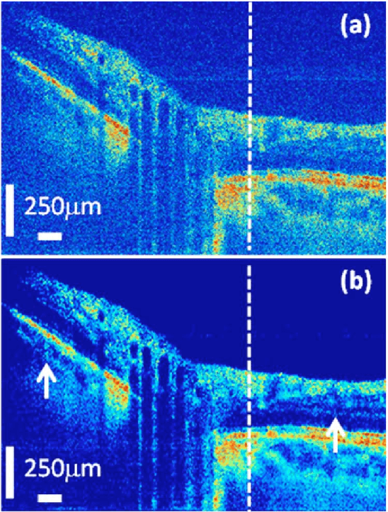 Figure 4 for State-of-the-Art in Retinal Optical Coherence Tomography Image Analysis