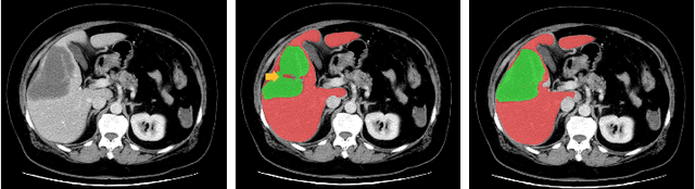 Figure 2 for Semantic Feature Attention Network for Liver Tumor Segmentation in Large-scale CT database