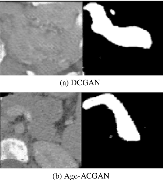 Figure 2 for Age-Conditioned Synthesis of Pediatric Computed Tomography with Auxiliary Classifier Generative Adversarial Networks