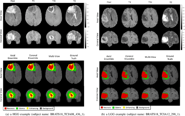 Figure 4 for Attention-Guided Version of 2D UNet for Automatic Brain Tumor Segmentation