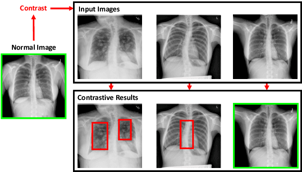 Figure 1 for Contrastive Attention for Automatic Chest X-ray Report Generation