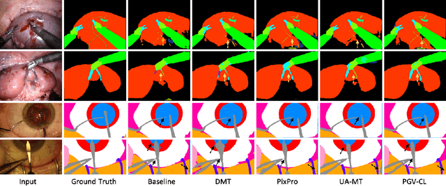 Figure 4 for Pseudo-label Guided Cross-video Pixel Contrast for Robotic Surgical Scene Segmentation with Limited Annotations