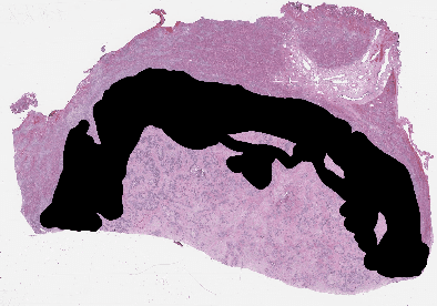 Figure 2 for Selecting Regions of Interest in Large Multi-Scale Images for Cancer Pathology