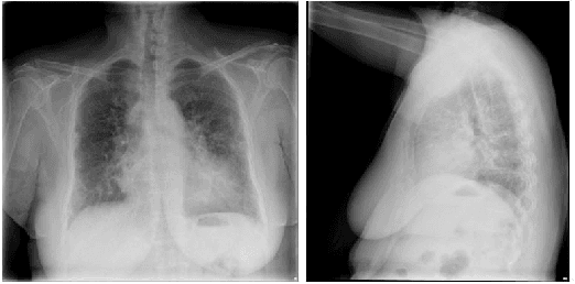Figure 1 for Addressing Data Bias Problems for Chest X-ray Image Report Generation
