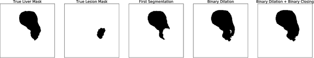 Figure 2 for Liver Lesion Segmentation with slice-wise 2D Tiramisu and Tversky loss function