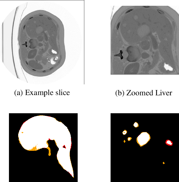 Figure 3 for Liver Lesion Segmentation with slice-wise 2D Tiramisu and Tversky loss function