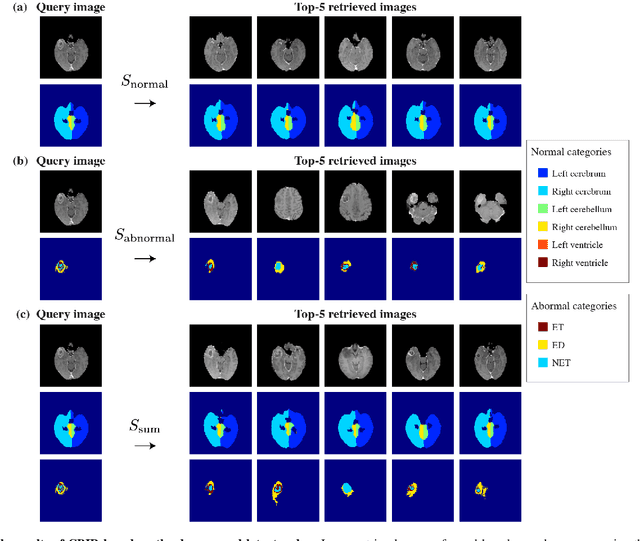 Figure 4 for Decomposing Normal and Abnormal Features of Medical Images into Discrete Latent Codes for Content-Based Image Retrieval