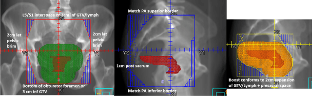 Figure 1 for Automation of Radiation Treatment Planning for Rectal Cancer