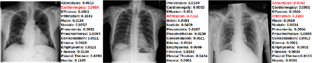 Figure 2 for Self-supervised Mean Teacher for Semi-supervised Chest X-ray Classification