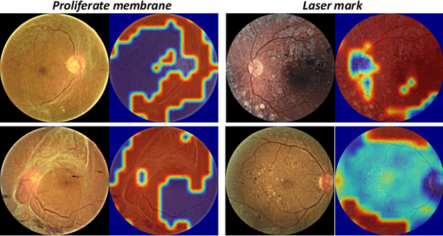 Figure 3 for A Benchmark for Studying Diabetic Retinopathy: Segmentation, Grading, and Transferability