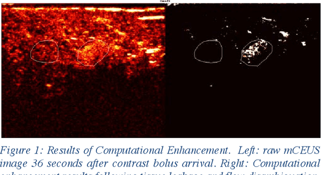 Figure 1 for Computational Enhancement of Molecularly Targeted Contrast-Enhanced Ultrasound: Application to Human Breast Tumor Imaging