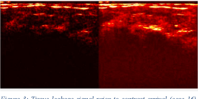 Figure 3 for Computational Enhancement of Molecularly Targeted Contrast-Enhanced Ultrasound: Application to Human Breast Tumor Imaging