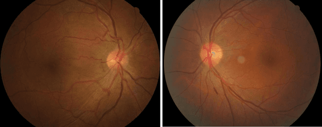 Figure 1 for Assessment of central serous chorioretinopathy (CSC) depicted on color fundus photographs using deep Learning