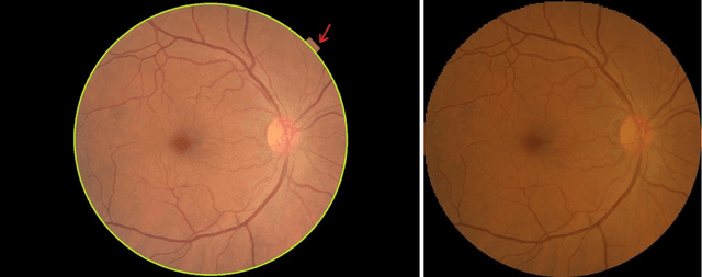 Figure 3 for Assessment of central serous chorioretinopathy (CSC) depicted on color fundus photographs using deep Learning