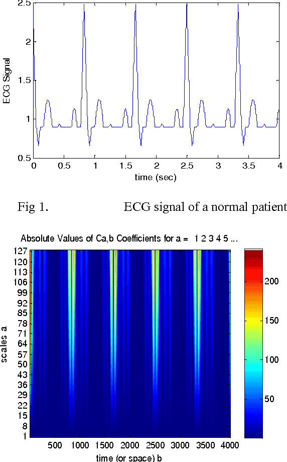 Figure 1 for Feature Extraction of ECG Signal Using HHT Algorithm