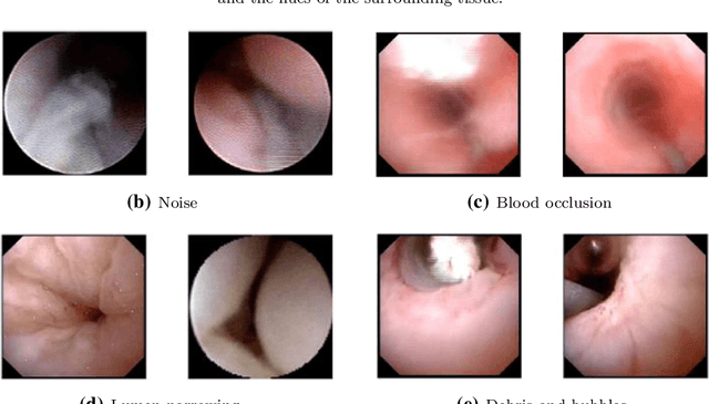 Figure 1 for Using spatial-temporal ensembles of convolutional neural networks for lumen segmentation in ureteroscopy