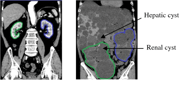 Figure 1 for Computation of Total Kidney Volume from CT images in Autosomal Dominant Polycystic Kidney Disease using Multi-Task 3D Convolutional Neural Networks
