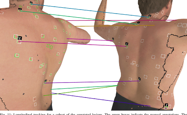 Figure 3 for Detection and Longitudinal Tracking of Pigmented Skin Lesions in 3D Total-Body Skin Textured Meshes