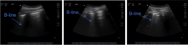 Figure 1 for B-line Detection in Lung Ultrasound Videos: Cartesian vs Polar Representation