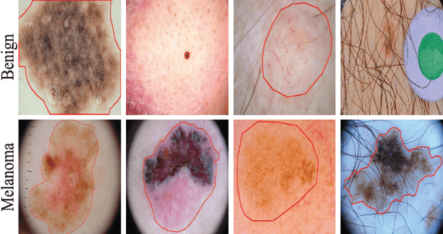 Figure 1 for Bi-directional Dermoscopic Feature Learning and Multi-scale Consistent Decision Fusion for Skin Lesion Segmentation