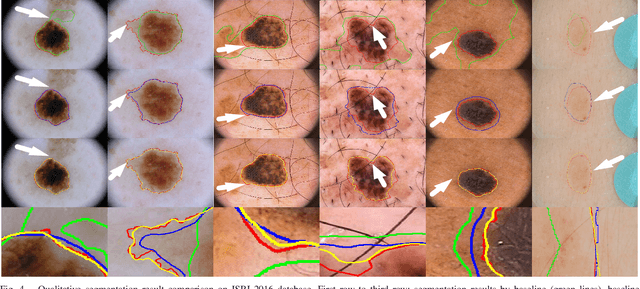 Figure 4 for Bi-directional Dermoscopic Feature Learning and Multi-scale Consistent Decision Fusion for Skin Lesion Segmentation