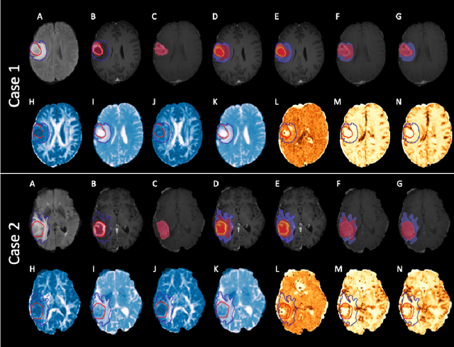 Figure 4 for Expectation-Maximization Regularized Deep Learning for Weakly Supervised Tumor Segmentation for Glioblastoma