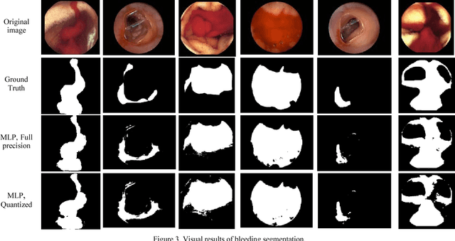 Figure 4 for Segmentation of Bleeding Regions in Wireless Capsule Endoscopy Images an Approach for inside Capsule Video Summarization