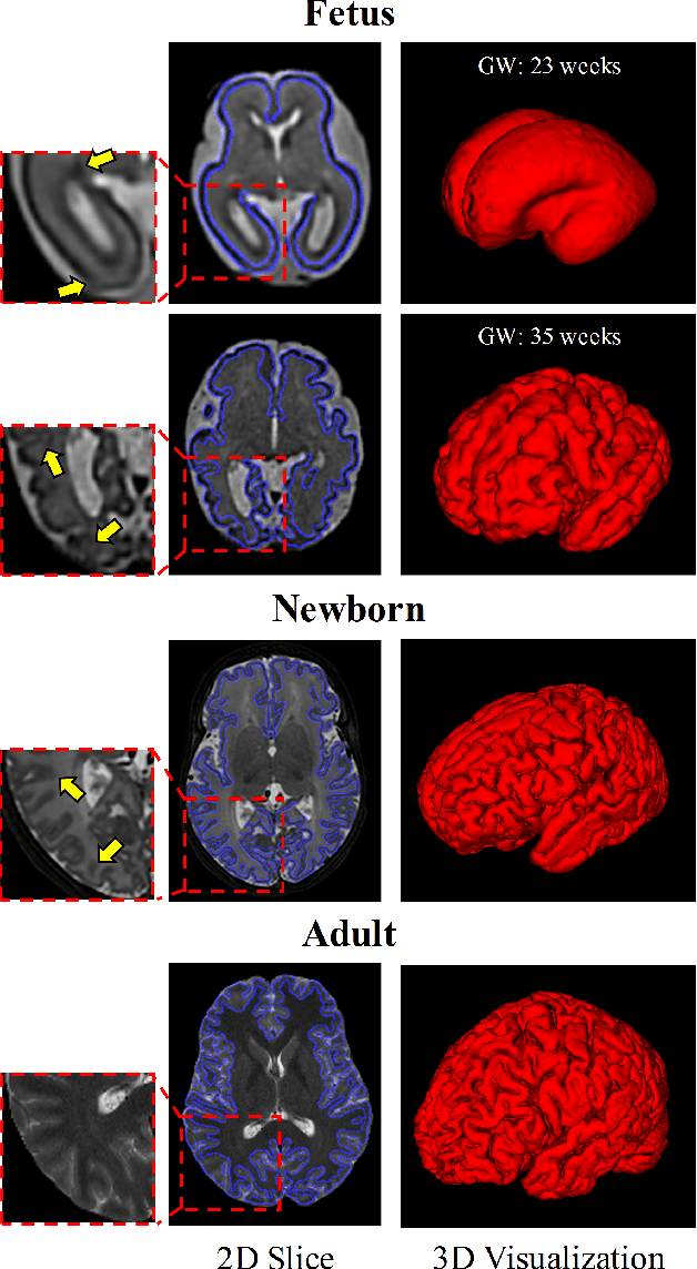 Figure 1 for A Deep Attentive Convolutional Neural Network for Automatic Cortical Plate Segmentation in Fetal MRI
