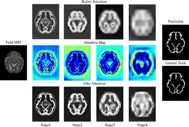 Figure 4 for A Deep Attentive Convolutional Neural Network for Automatic Cortical Plate Segmentation in Fetal MRI