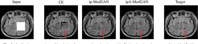 Figure 3 for ipA-MedGAN: Inpainting of Arbitrarily Regions in Medical Modalities