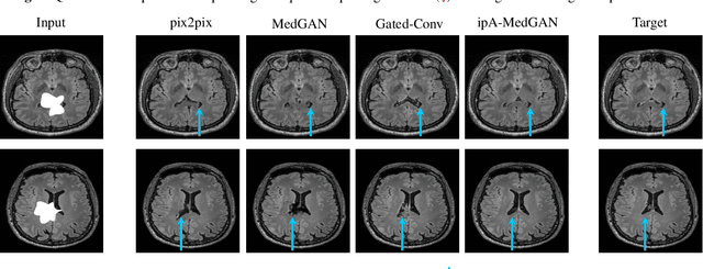 Figure 4 for ipA-MedGAN: Inpainting of Arbitrarily Regions in Medical Modalities