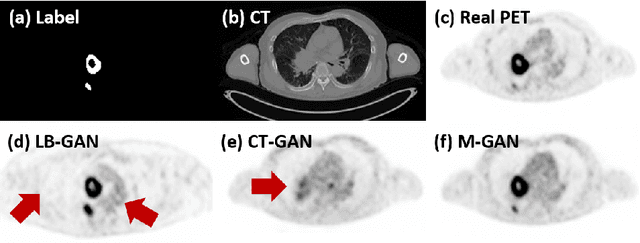 Figure 3 for Synthesis of Positron Emission Tomography (PET) Images via Multi-channel Generative Adversarial Networks (GANs)