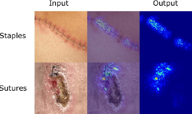 Figure 3 for Deepwound: Automated Postoperative Wound Assessment and Surgical Site Surveillance through Convolutional Neural Networks