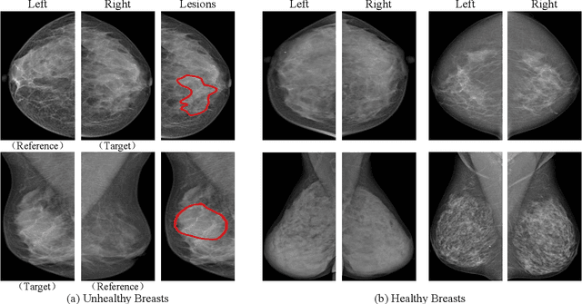 Figure 1 for Bilateral Asymmetry Guided Counterfactual Generating Network for Mammogram Classification