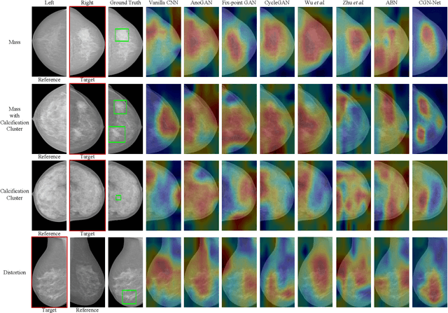 Figure 4 for Bilateral Asymmetry Guided Counterfactual Generating Network for Mammogram Classification