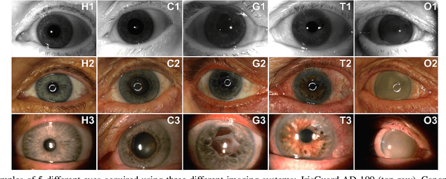 Figure 2 for Assessment of iris recognition reliability for eyes affected by ocular pathologies