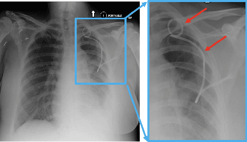 Figure 1 for Pneumothorax and chest tube classification on chest x-rays for detection of missed pneumothorax