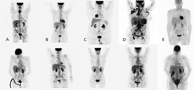 Figure 2 for RADIOGAN: Deep Convolutional Conditional Generative adversarial Network To Generate PET Images