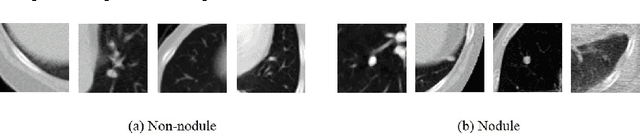 Figure 3 for Multi-stage Neural Networks with Single-sided Classifiers for False Positive Reduction and its Evaluation using Lung X-ray CT Images