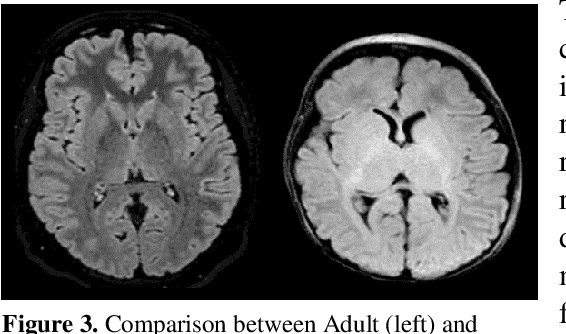 Figure 3 for Deep Learning Mixture-of-Experts Approach for Cytotoxic Edema Assessment in Infants and Children