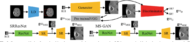 Figure 1 for How Can We Make GAN Perform Better in Single Medical Image Super-Resolution? A Lesion Focused Multi-Scale Approach