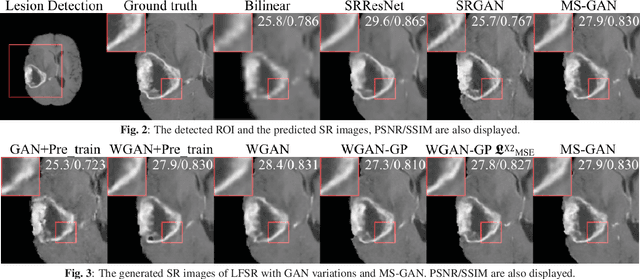 Figure 3 for How Can We Make GAN Perform Better in Single Medical Image Super-Resolution? A Lesion Focused Multi-Scale Approach