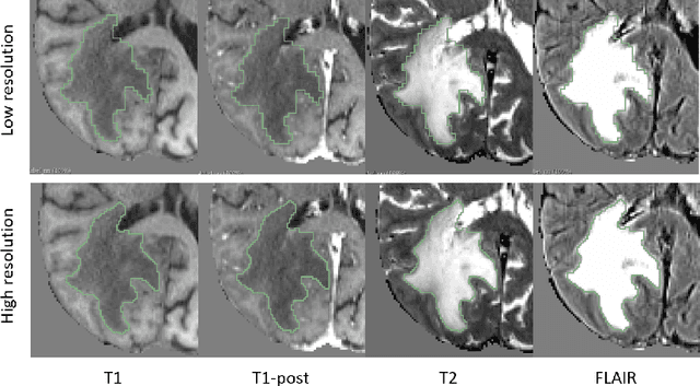 Figure 2 for Sequential 3D U-Nets for Biologically-Informed Brain Tumor Segmentation