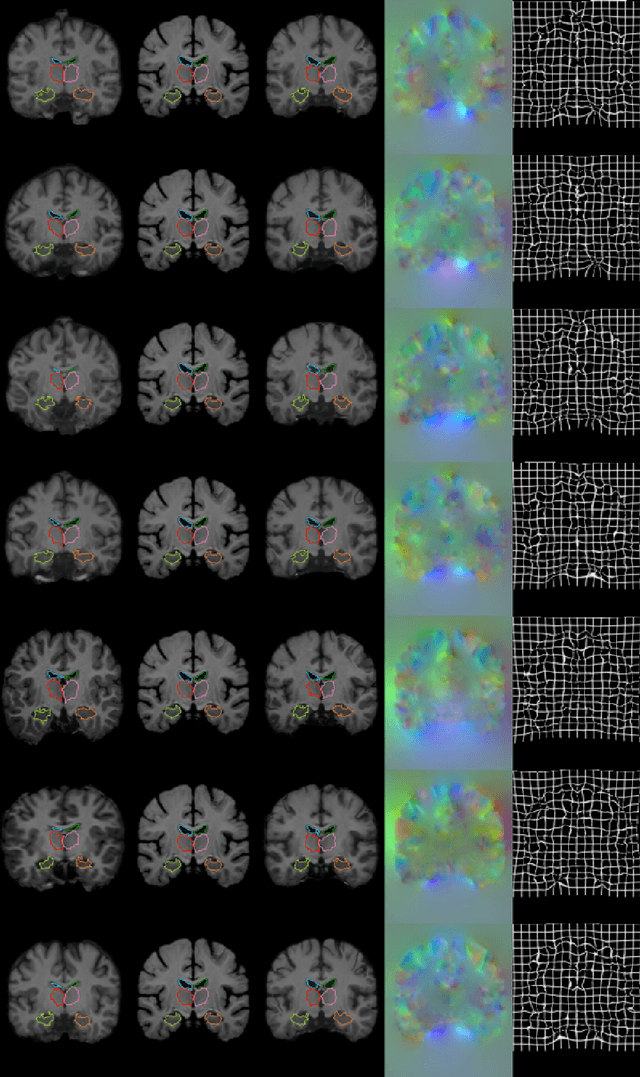 Figure 3 for VoxelMorph: A Learning Framework for Deformable Medical Image Registration