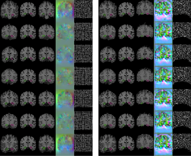 Figure 4 for VoxelMorph: A Learning Framework for Deformable Medical Image Registration