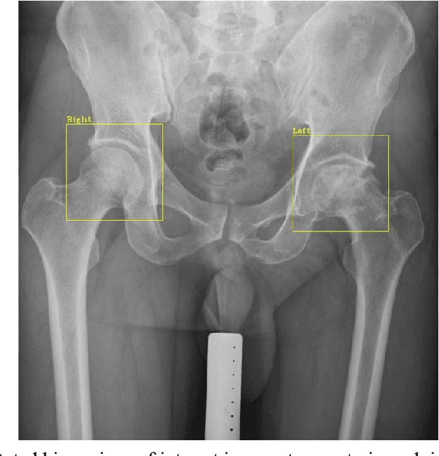 Figure 3 for A Practical Framework for ROI Detection in Medical Images -- a case study for hip detection in anteroposterior pelvic radiographs