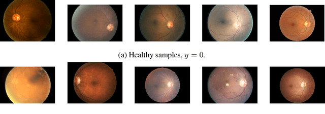 Figure 3 for A Systematic Comparison of Bayesian Deep Learning Robustness in Diabetic Retinopathy Tasks