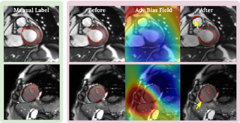 Figure 3 for Realistic Adversarial Data Augmentation for MR Image Segmentation