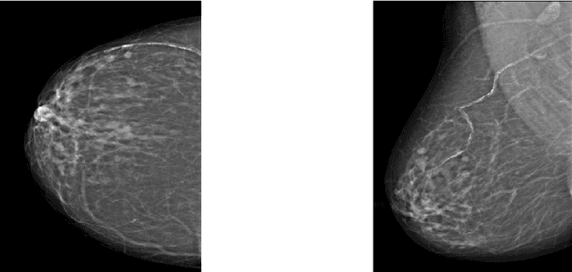 Figure 2 for Improving Specificity in Mammography Using Cross-correlation between Wavelet and Fourier Transform